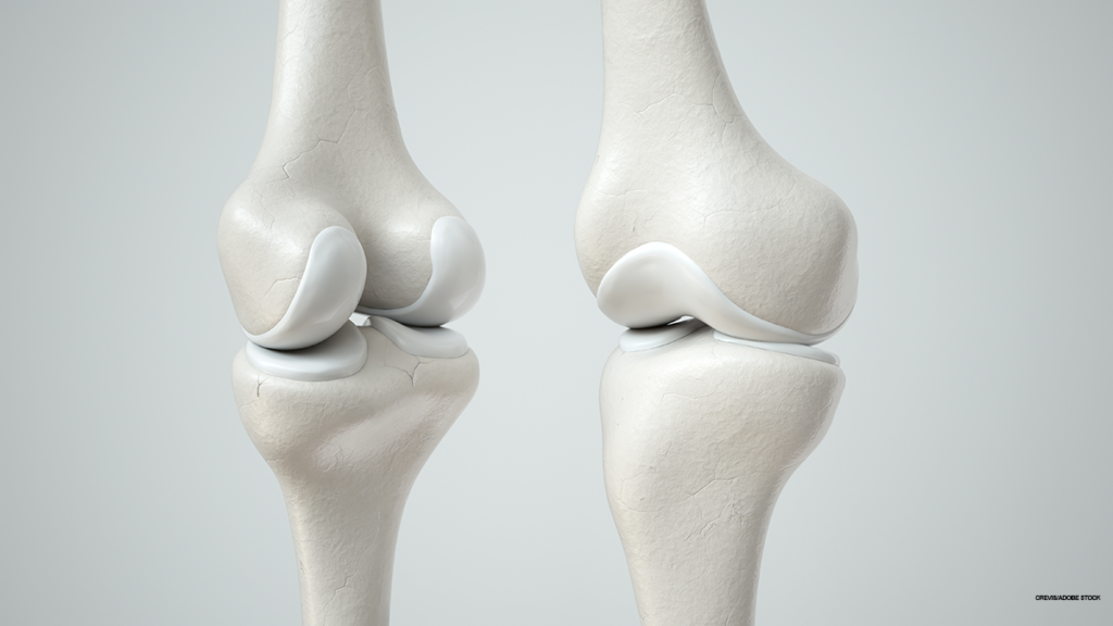 Como entender e prevenir uma lesão na cartilagem do joelho